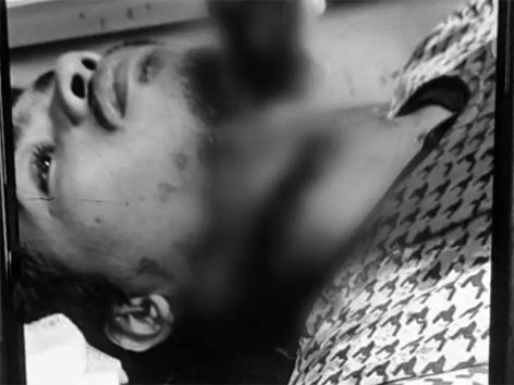 चाइनीज मांझे से दो युवकों के गले कटे : एक की सांस की नली कटी, 45 मिनट चली सर्जरी, बाइक सवार पति-पत्नी भी घायल