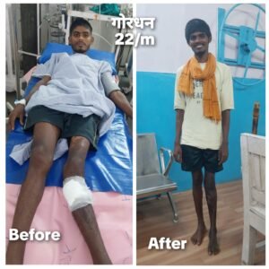 जिला चिकित्सालय रतलाम में मिला नया जीवन,चलने फिरने में लाचार गोरधन को